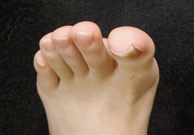 BSブレイス(巻き爪改善)